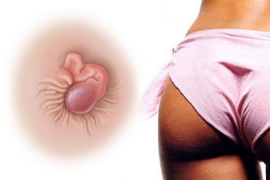 Crema naturale cure emorroidi in un unico corso